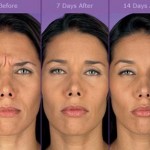 Wrinkle Treatment – dispelling the myths…